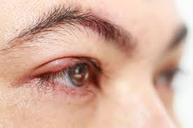 How do you get rid of a stye in 5 minutes